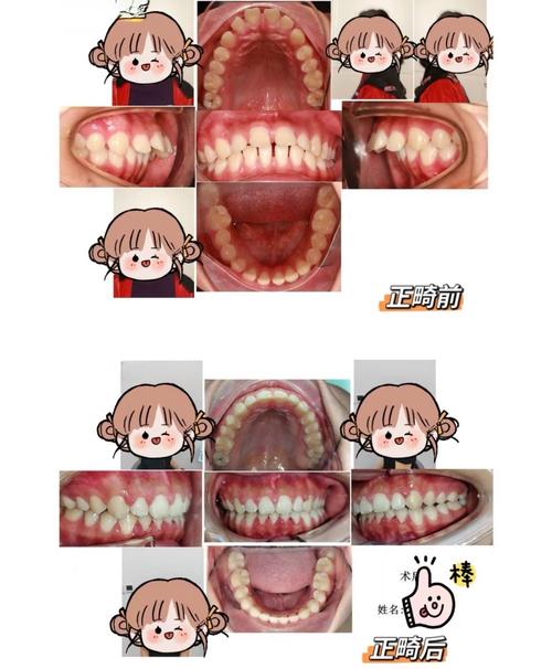 牙齿矫正中大牙后移有何作用?过程和注意事项有哪些?-图2 牙齿矫正中大牙后移有何作用?过程和注意事项有哪些?-图2