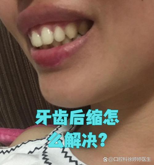 牙齿矫正中大牙后移有何作用?过程和注意事项有哪些?-图3 牙齿矫正中大牙后移有何作用?过程和注意事项有哪些?-图3