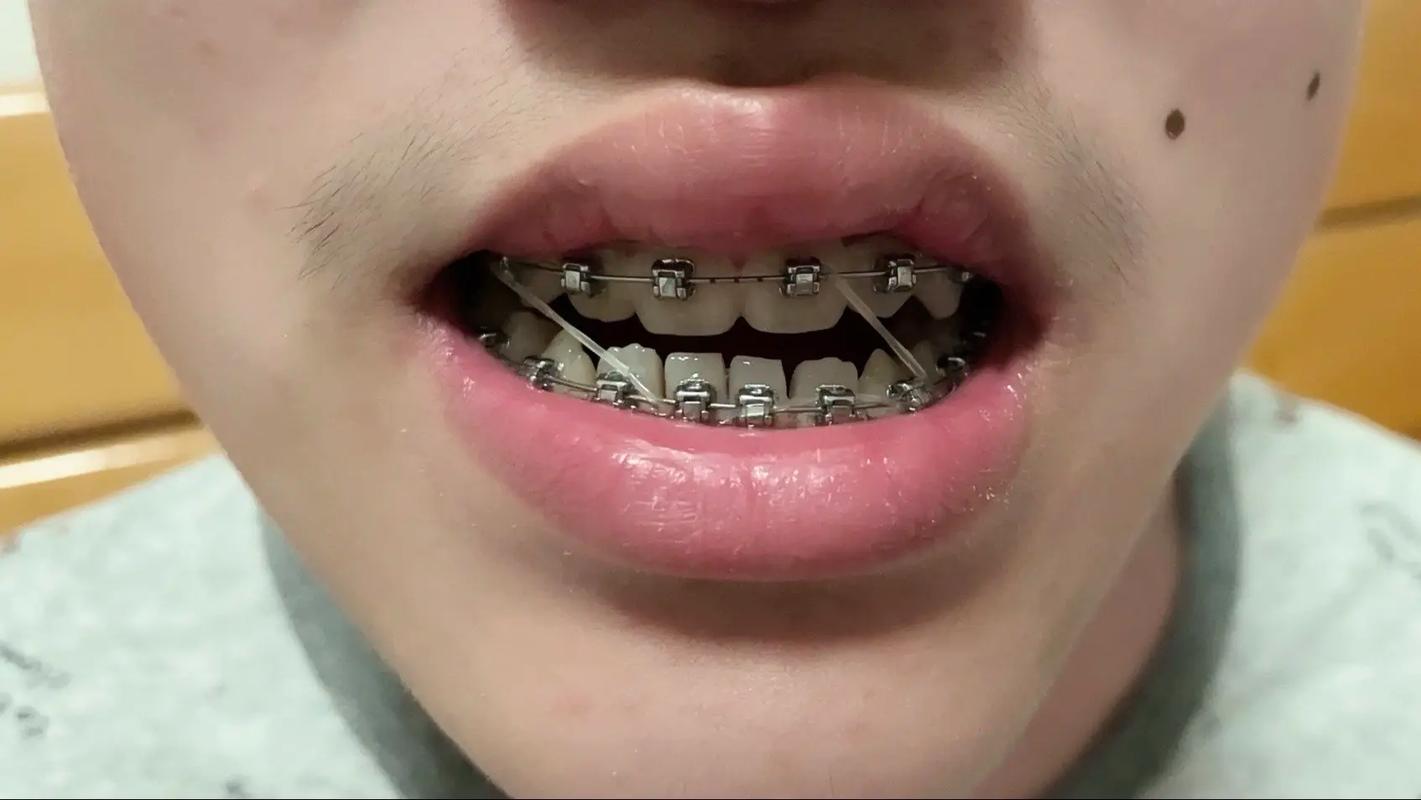 矫正牙齿不做牙模-图2