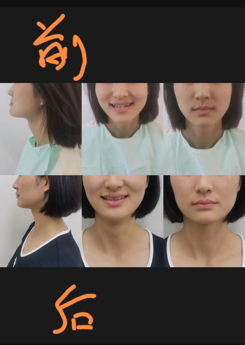 牙齿矫正下巴前后对比,差异明显吗?-图1 牙齿矫正下巴前后对比,差异明显吗?-图1