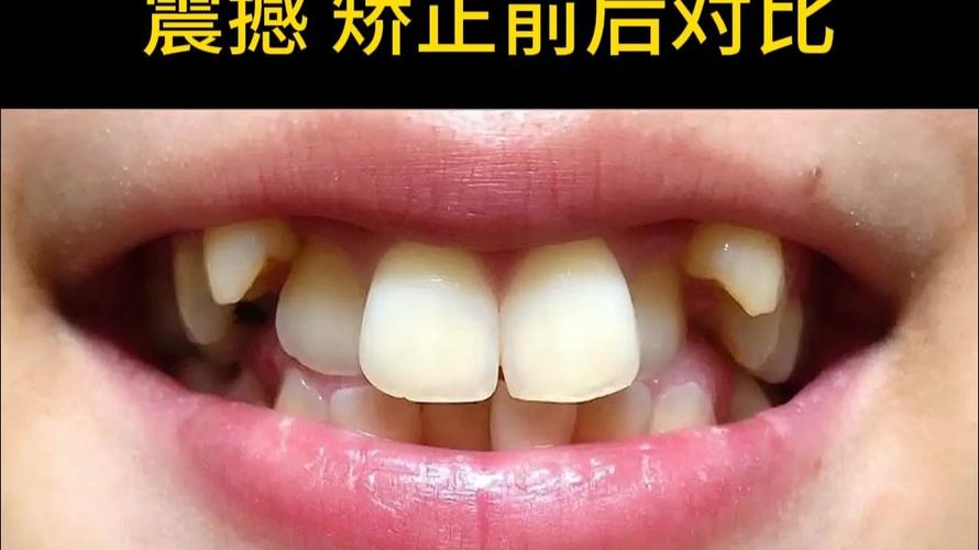 21岁想矫正牙齿-图1