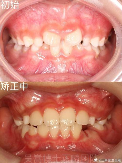 牙齿有缝普通矫正-图3