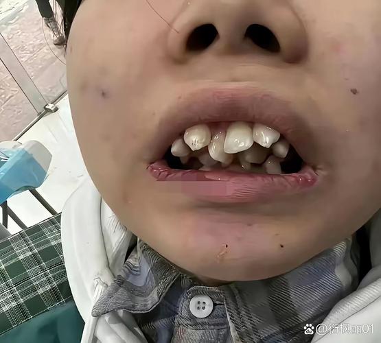 矫正牙齿后人中变长，是正常现象吗？-图3