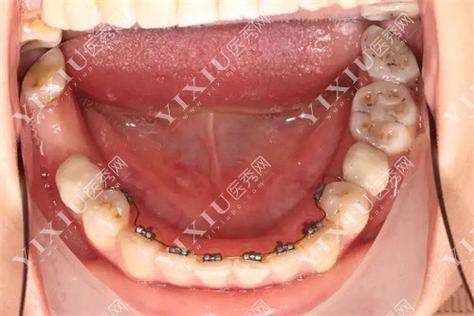 舌侧矫正对牙齿咬合的调整效果具体如何？-图3