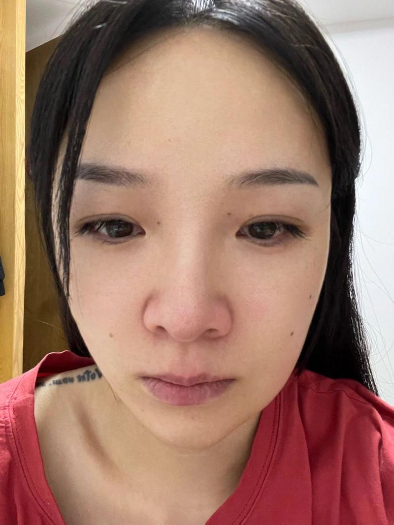 牙齿矫正后脸肿了?是正常反应还是需警惕?-图1 牙齿矫正后脸肿了?是正常反应还是需警惕?-图1
