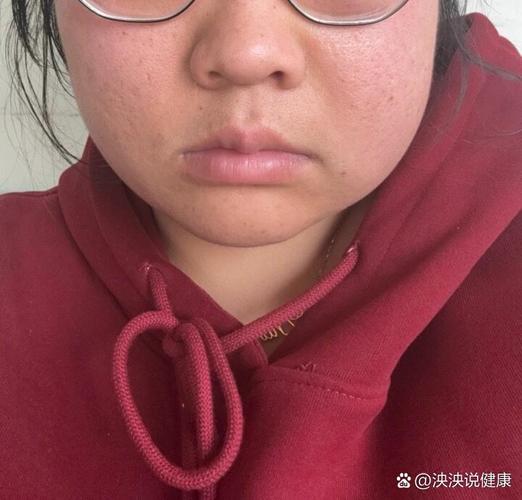牙齿矫正后脸肿了?是正常反应还是需警惕?-图2 牙齿矫正后脸肿了?是正常反应还是需警惕?-图2