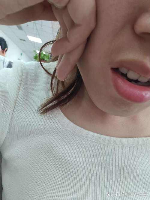 牙齿矫正后脸肿了?是正常反应还是需警惕?-图3 牙齿矫正后脸肿了?是正常反应还是需警惕?-图3