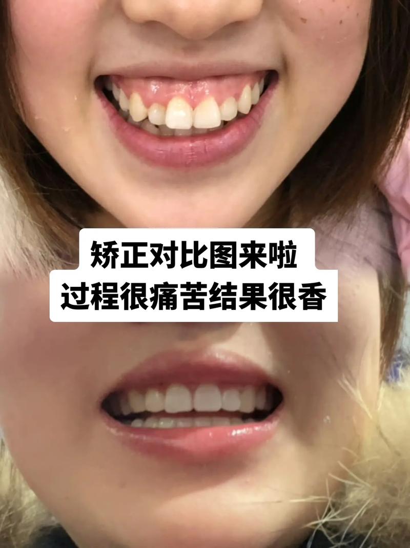 牙齿矫正后悔哭?后悔效果不如预期?还是过程太痛苦?-图1 牙齿矫正后悔哭?后悔效果不如预期?还是过程太痛苦?-图1