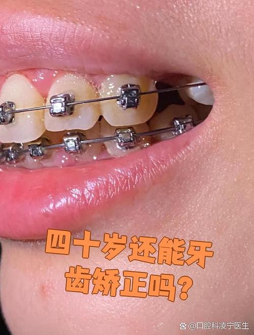 22岁矫正牙齿还来得及吗?效果会受年龄影响吗?-图2 22岁矫正牙齿还来得及吗?效果会受年龄影响吗?-图2