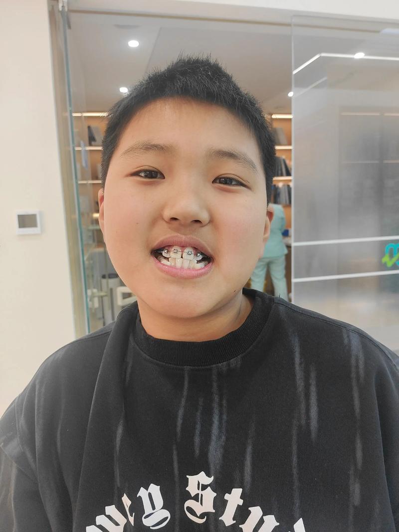 牙齿矫正中途停止-图2