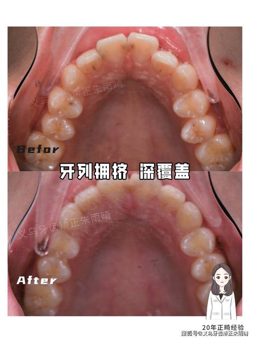 矫正后深覆盖为何出现?如何应对?-图3 矫正后深覆盖为何出现?如何应对?-图3