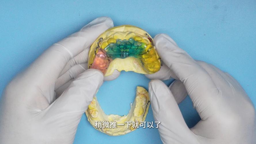 矫正牙齿前，具体需要做哪些准备工作？-图1