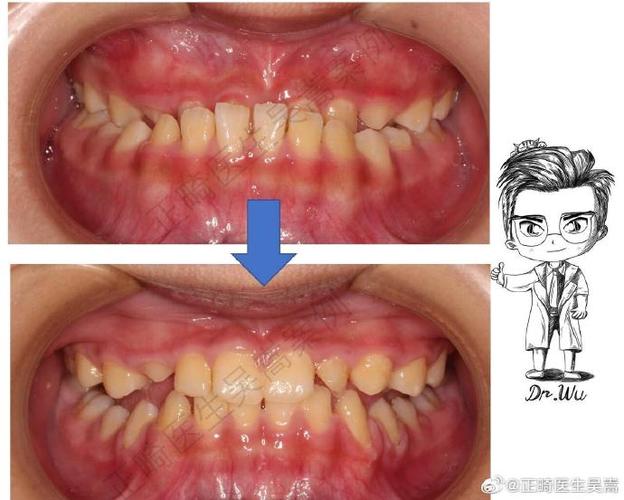 南京7天矫正牙齿真的靠谱吗？效果与安全如何？-图2