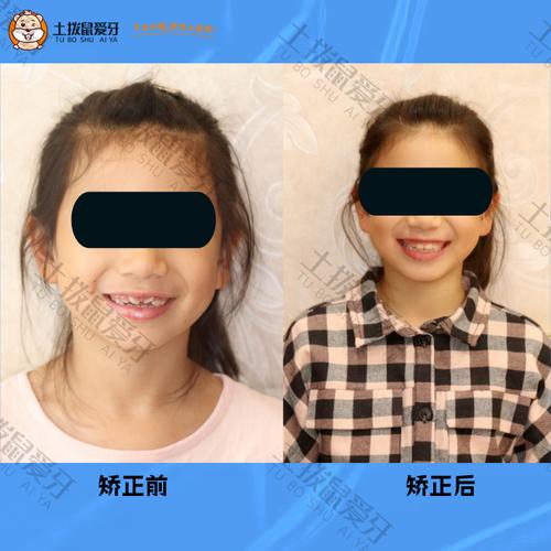 上海小儿牙齿矫正，几岁开始矫正效果最佳？-图3