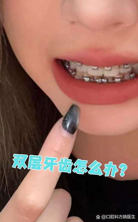 双层牙齿后期矫正-图3