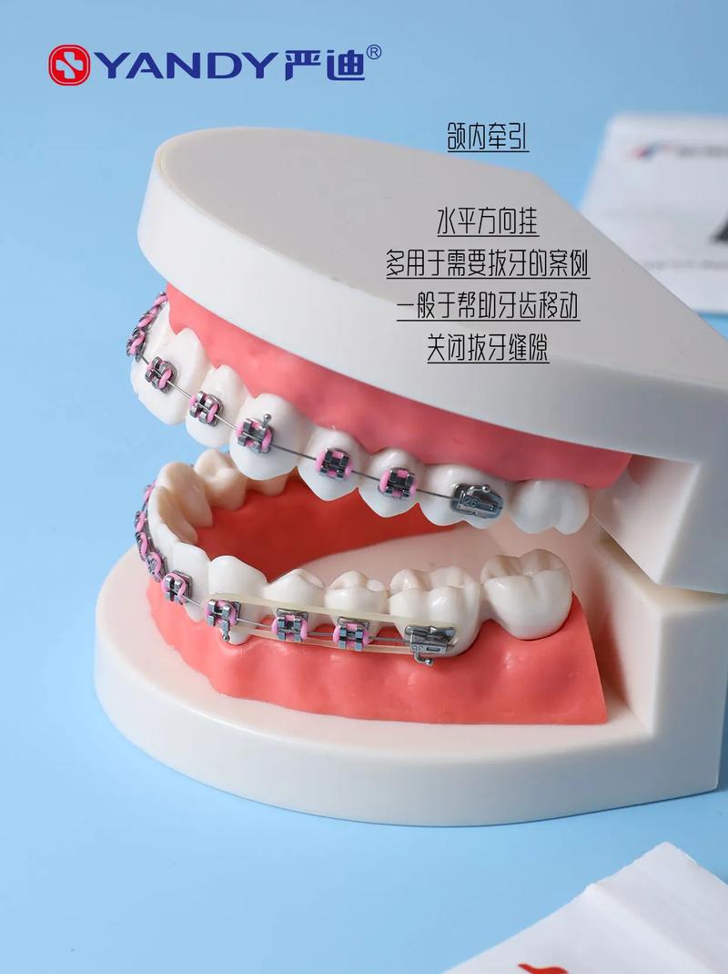 牙齿矫正皮筋牵引有何作用?如何正确使用?-图2 牙齿矫正皮筋牵引有何作用?如何正确使用?-图2