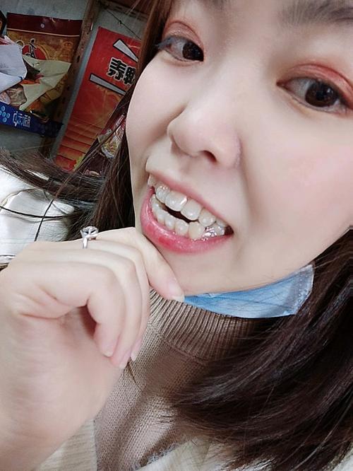 隐形矫正牙齿视频能看清牙齿矫正全过程和效果吗？-图2