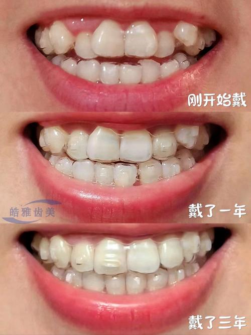 隐形矫正牙齿视频能看清牙齿矫正全过程和效果吗？-图3