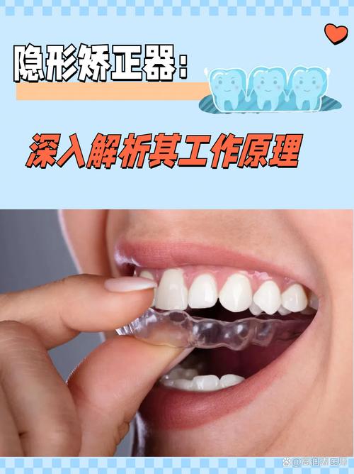 烟台牙齿隐形矫正效果如何？价格贵不贵？适合哪些人？-图1