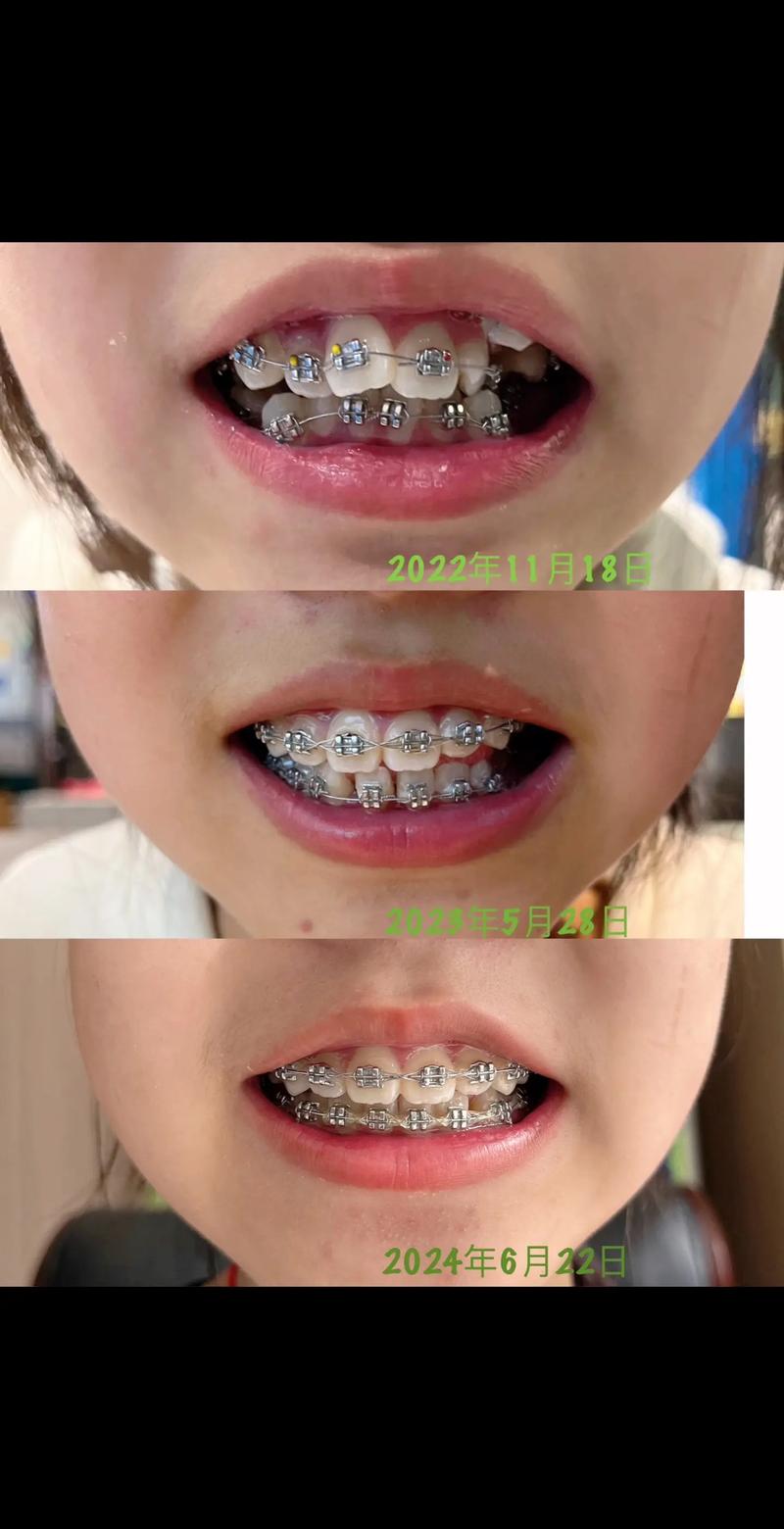 牙齿矫正后保持器要戴多久？-图2