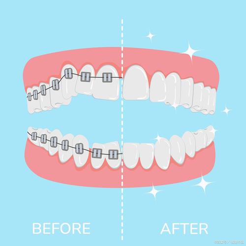 矫正牙齿几岁不能做？年龄限制范围是？-图2