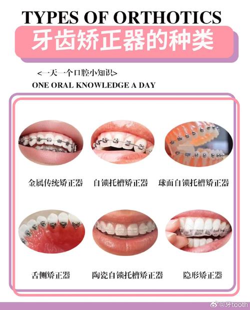 牙齿手术矫正有哪些常见种类？不同类型适用哪些牙齿问题？-图3