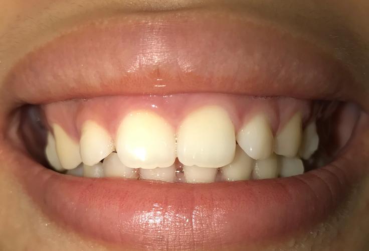 牙齿稀疏隐形矫正有效吗？适合哪些人？要注意什么？-图2