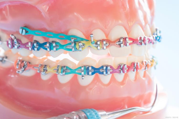 矫正牙齿要打骨钉-图1 矫正牙齿要打骨钉-图1