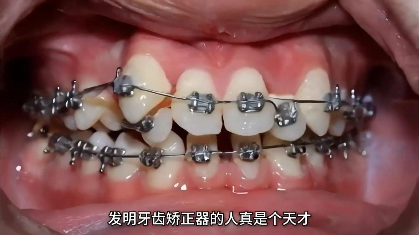 牙齿矫正该去哪里做?靠谱机构怎么选?-图1 牙齿矫正该去哪里做?靠谱机构怎么选?-图1