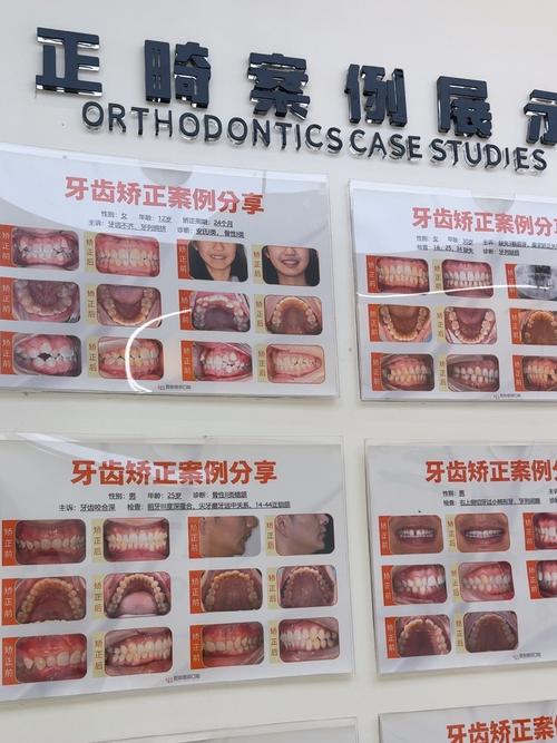 牙齿矫正设计方案如何制定才能兼顾效果与舒适？-图3