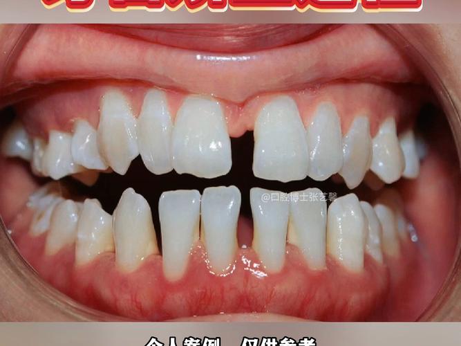 牙齿稀疏矫正容易吗？-图1