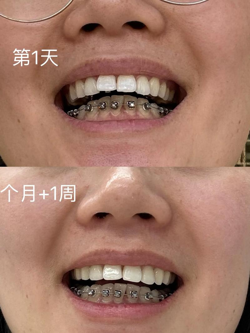 舌侧隐形矫正效果如何？适合哪些牙齿问题做？-图3