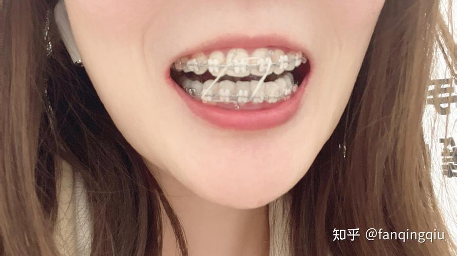 27岁矫正牙齿晚吗？效果和注意事项有哪些？-图2