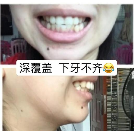 牙齿矫正后脸变小-图1 牙齿矫正后脸变小-图1