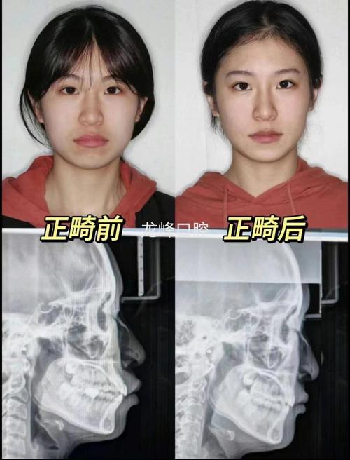 牙齿矫正后脸变小-图2 牙齿矫正后脸变小-图2