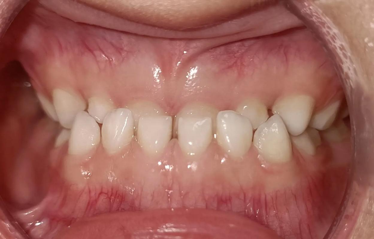 牙齿矫正只做上排，效果真的能好吗？-图1