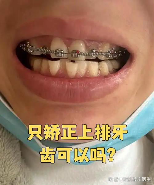 牙齿矫正只做上排，效果真的能好吗？-图3