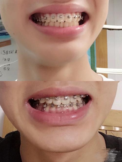 牙齿矫正钢丝脱落了，该怎么处理？-图1