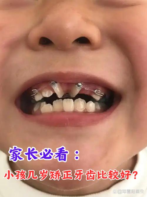 温州儿童牙齿矫正-图3