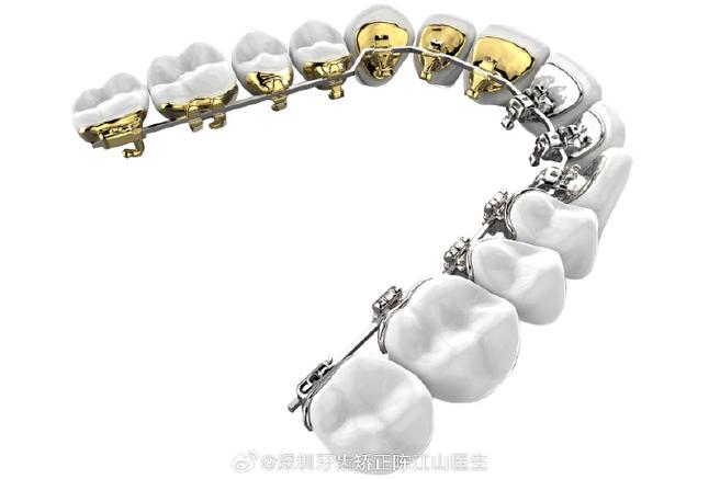 牙齿矫正托槽品牌怎么选？不同品牌效果和价格差异大吗？-图3