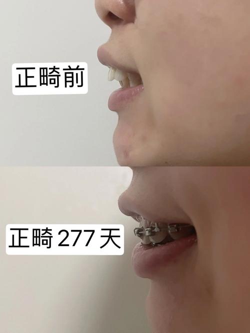 杭州畸形牙齿矫正效果怎样？哪种方法靠谱？-图1
