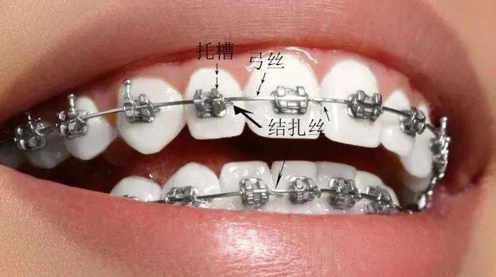 杭州畸形牙齿矫正效果怎样？哪种方法靠谱？-图2