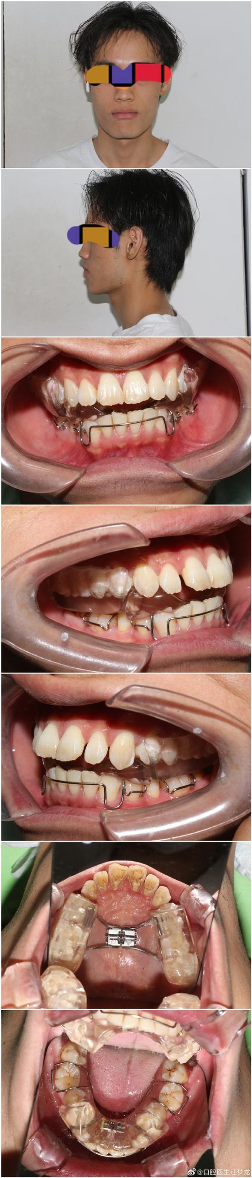 杭州畸形牙齿矫正效果怎样？哪种方法靠谱？-图3