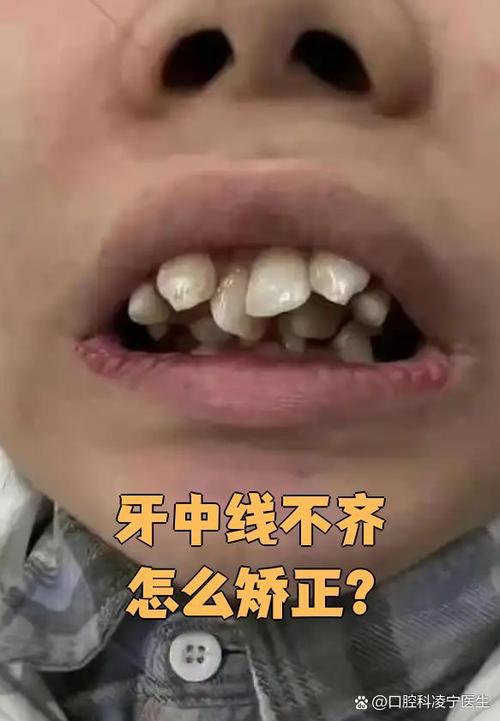 矫正牙齿中线偏移？是什么原因导致的又该如何有效矫正？-图2