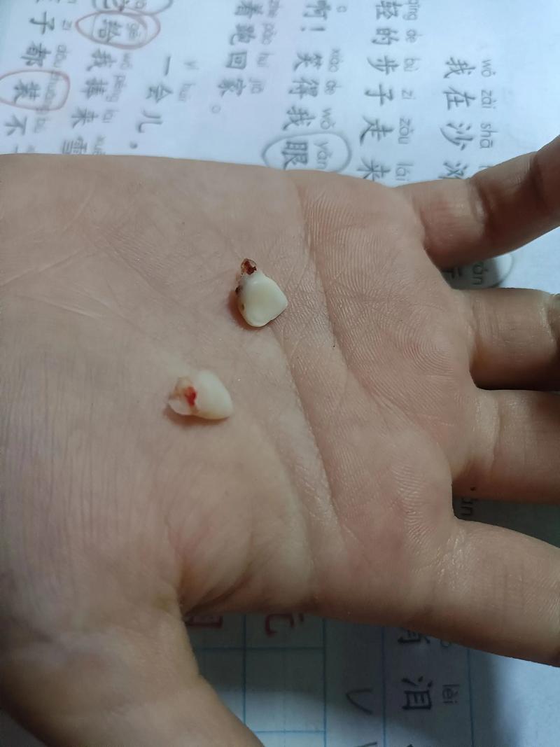 矫正牙齿门牙掉了-图1