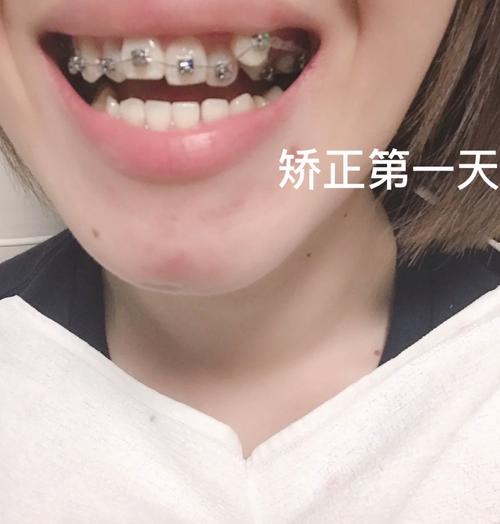 牙齿矫正第一个月,适应期会有哪些常见不适?如何应对?-图2 牙齿矫正第一个月,适应期会有哪些常见不适?如何应对?-图2