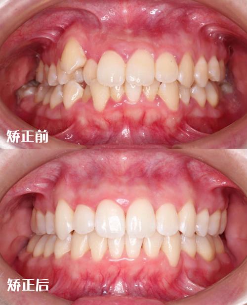矫正牙齿只做上面一排效果能达到预期吗？-图3