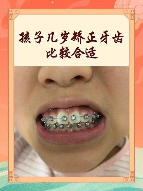 三十几岁矫正牙齿,年龄大了矫正还来得及吗?效果会打折扣吗?-图2 三十几岁矫正牙齿,年龄大了矫正还来得及吗?效果会打折扣吗?-图2