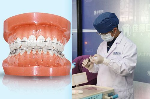 佳德口腔矫正牙齿效果好吗？适合哪些人？-图2