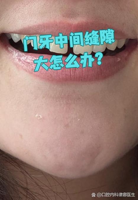 牙齿矫正完有缝隙-图2